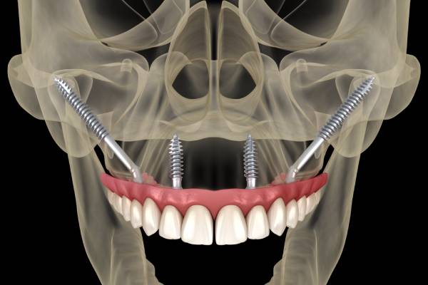 implantes cigomáticos